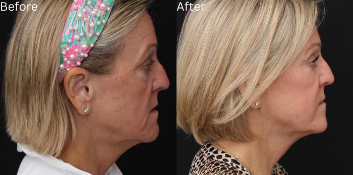 Before & After Juvederm Filler Case 60 View 3 View in Santa Rosa, California