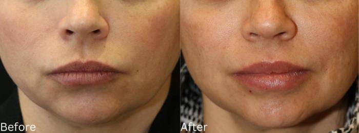 Before & After Juvederm Filler Case 61 View 1 View in Santa Rosa, California