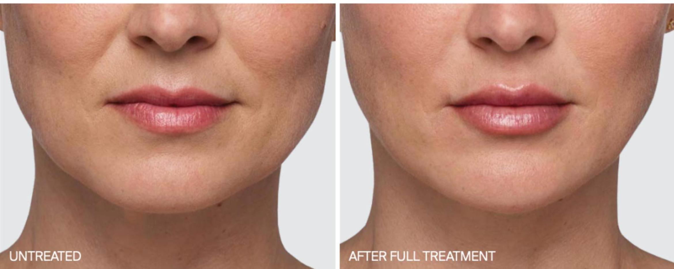 Before & After Juvederm Filler Case 62 View 1 View in Santa Rosa, California