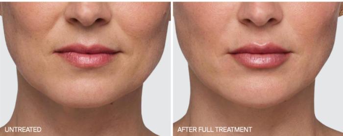 Before & After Juvederm Filler Case 62 View 1 View in Santa Rosa, California