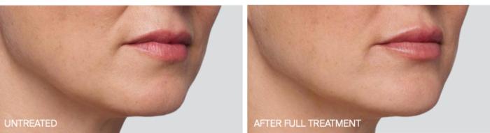 Before & After Juvederm Filler Case 62 View 2 View in Santa Rosa, California