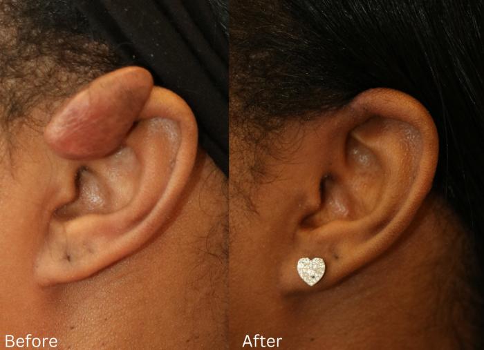 Before & After Keloid Removal Case 2 View 1 View in Santa Rosa, California