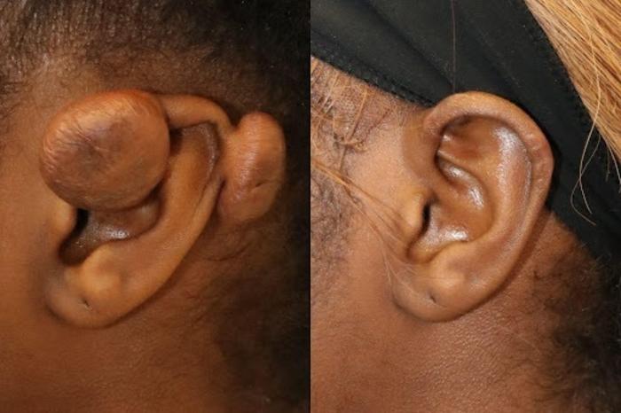 Before & After Keloid Removal Case 266 View 1 View in Santa Rosa, California