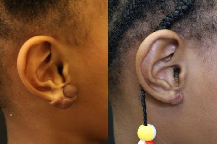 Before & After Keloid Removal Case 267 View 1 View in Santa Rosa, California