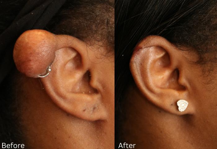 Before & After Keloid Removal Case 403 View 1 View in Santa Rosa, California