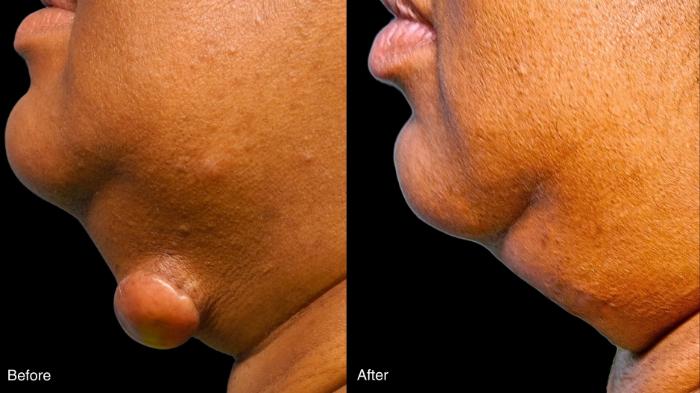 Before & After Keloid Removal Case 404 View 1 View in Santa Rosa, California