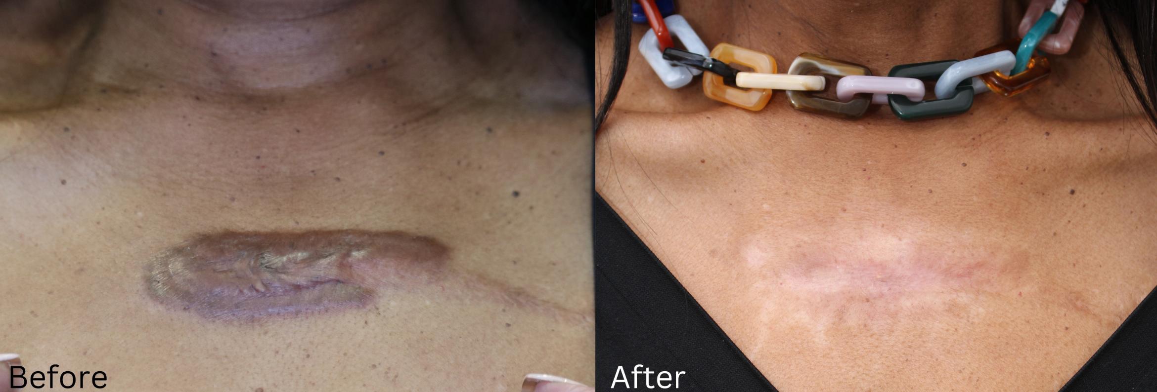 Before & After Keloid Removal Case 405 View 1 View in Santa Rosa, California