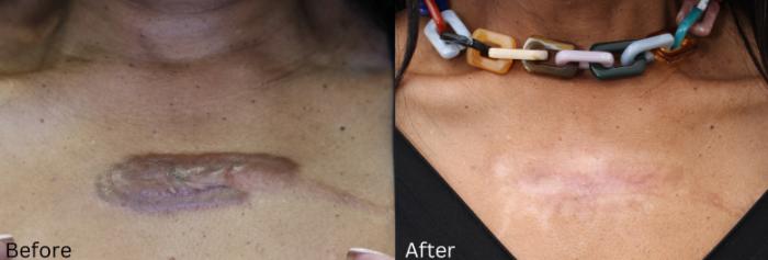 Before & After Keloid Removal Case 405 View 1 View in Santa Rosa, California