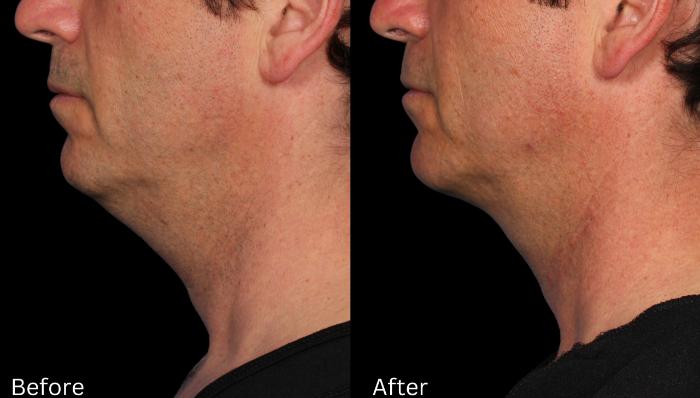 Before & After Kybella Case 237 View 1 View in Santa Rosa, California