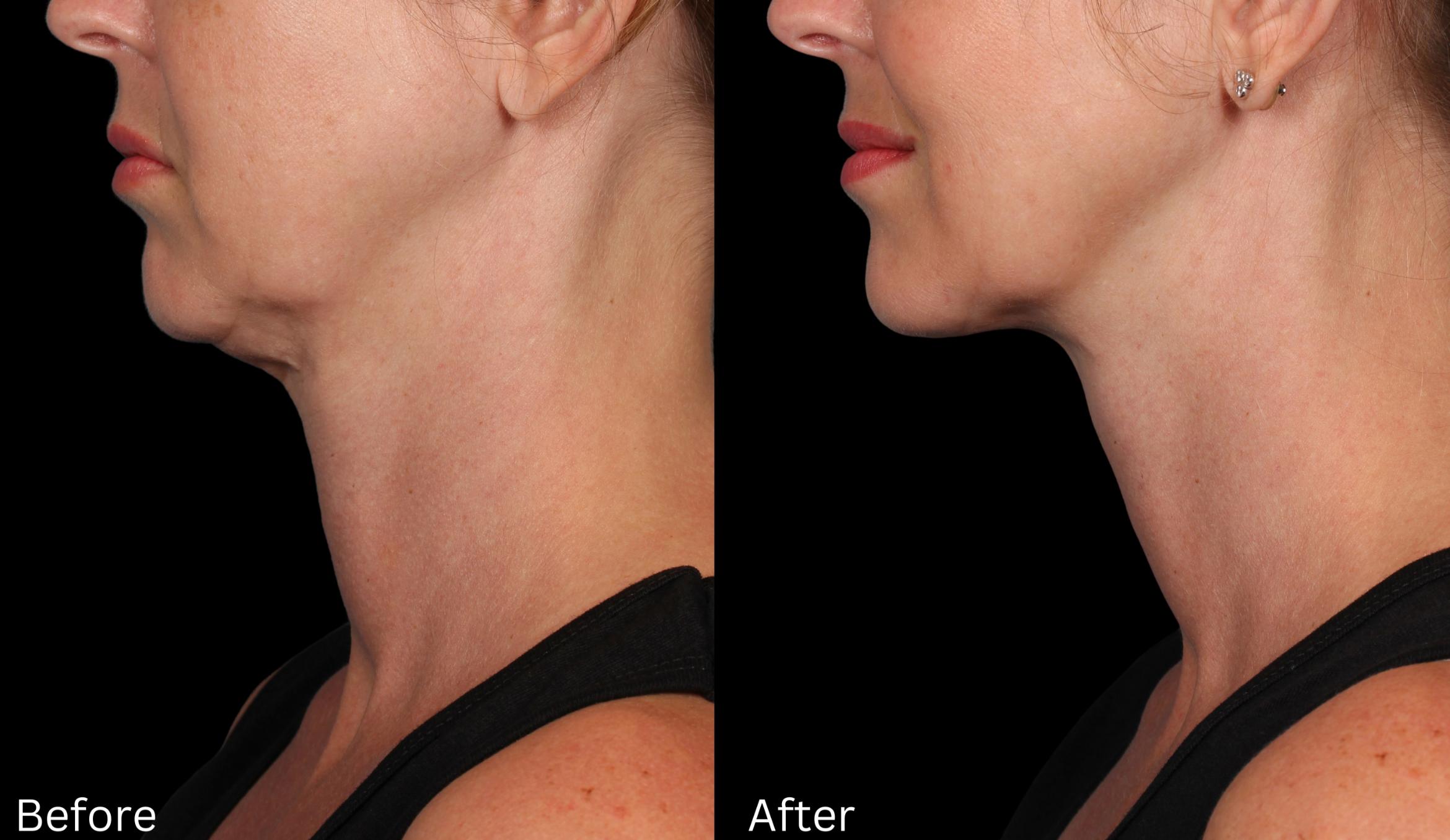 Before & After Kybella Case 238 View 1 View in Santa Rosa, California