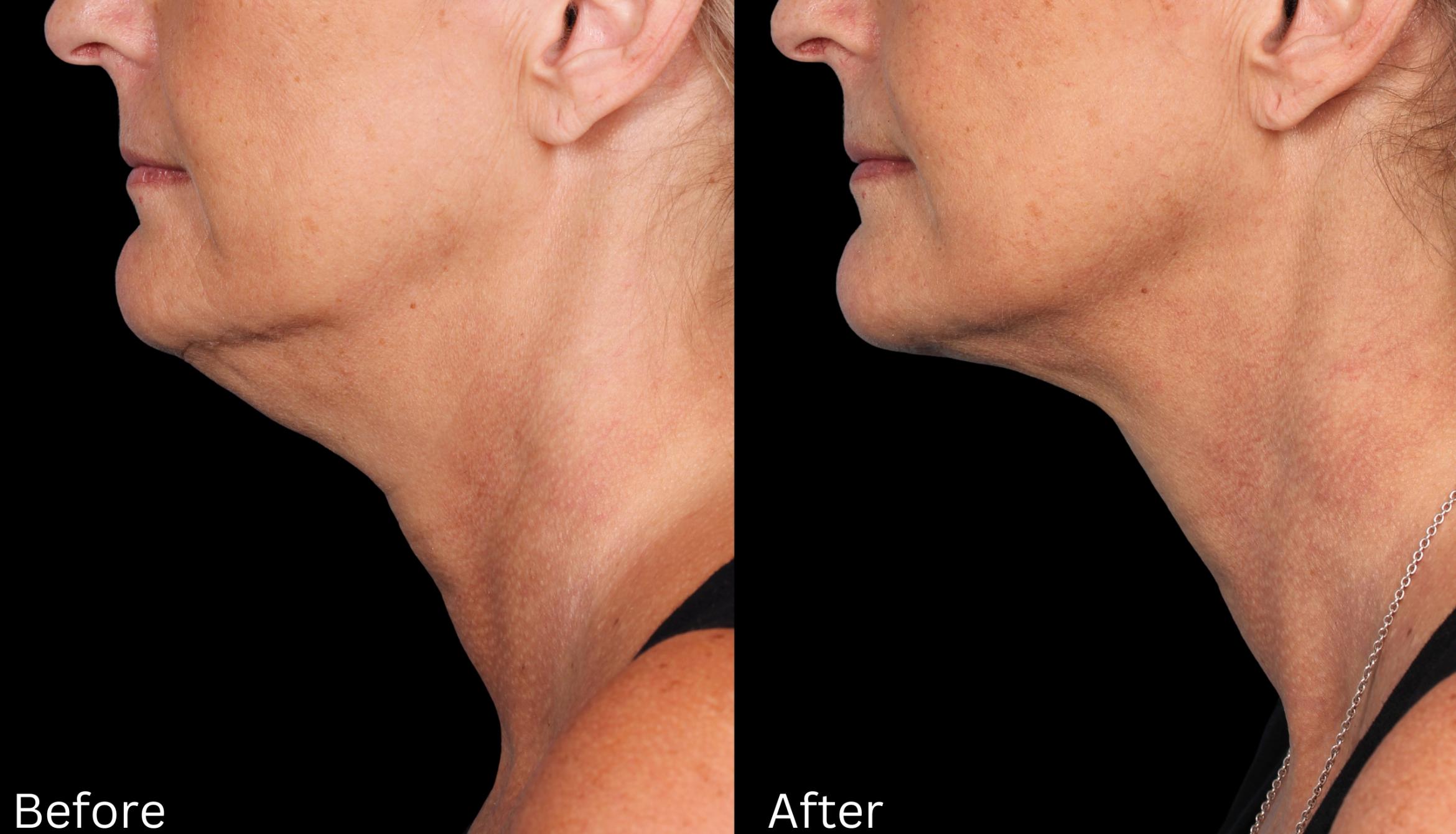 Before & After Kybella Case 55 View 1 View in Santa Rosa, California