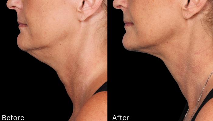 Before & After Kybella Case 55 View 1 View in Santa Rosa, California