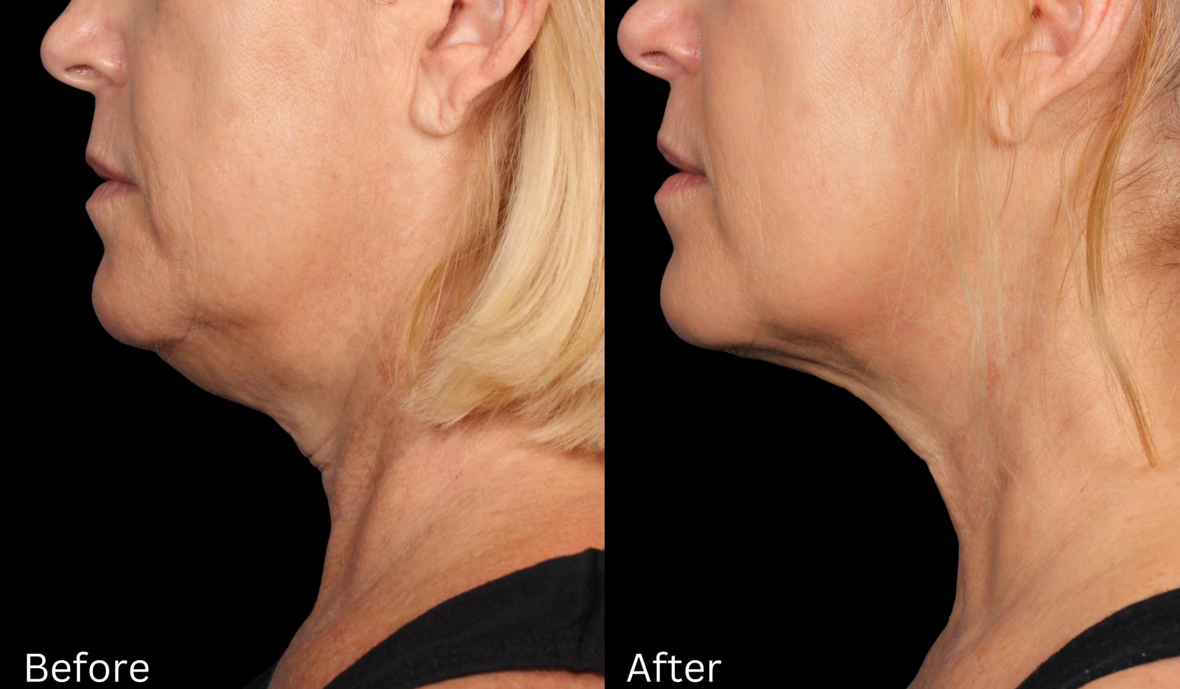 Before & After Kybella Case 56 View 1 View in Santa Rosa, California