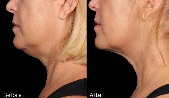 Before & After Kybella Case 56 View 1 View in Santa Rosa, California