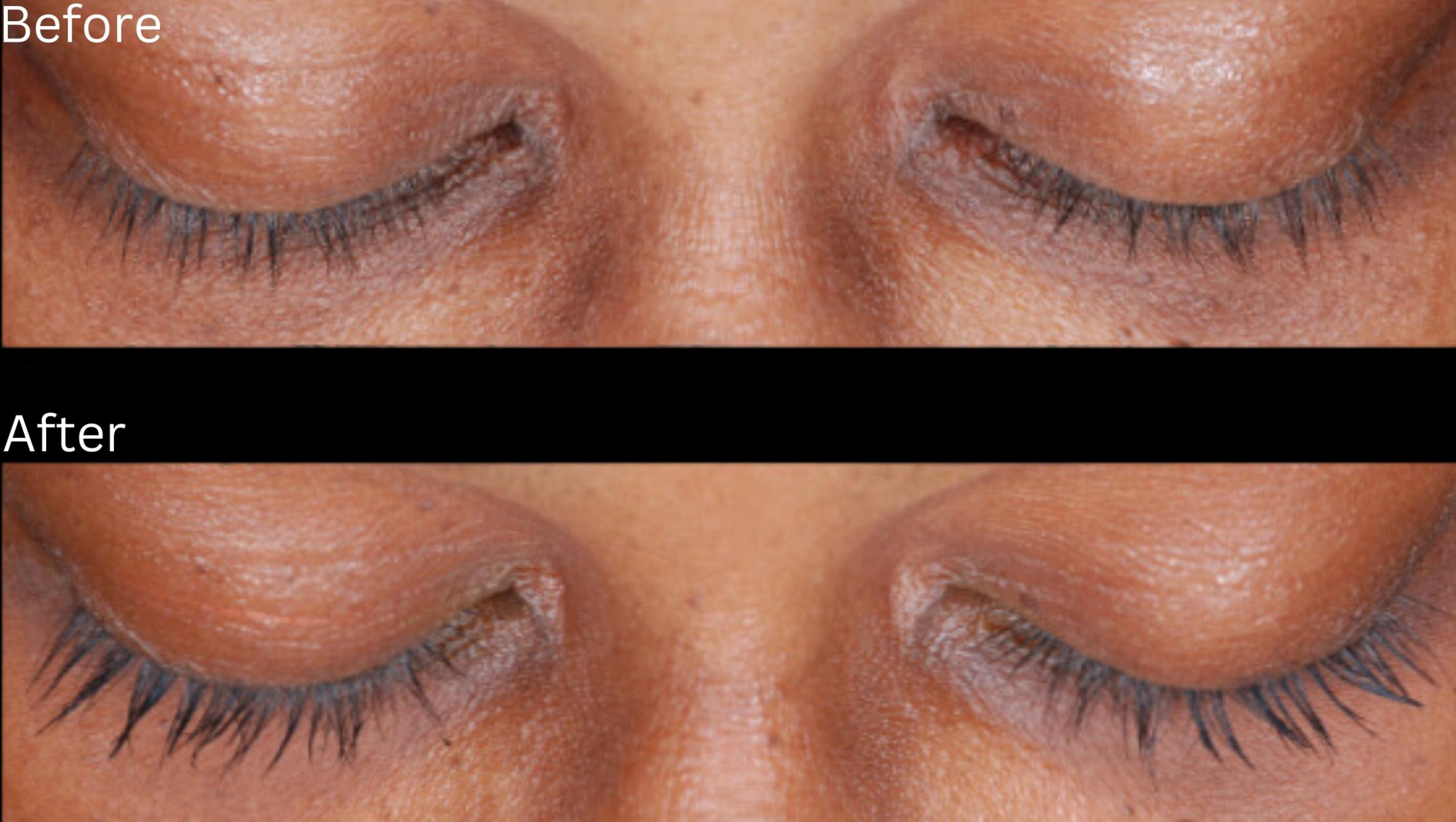 Before & After Latisse Case 354 View 1 View in Santa Rosa, California