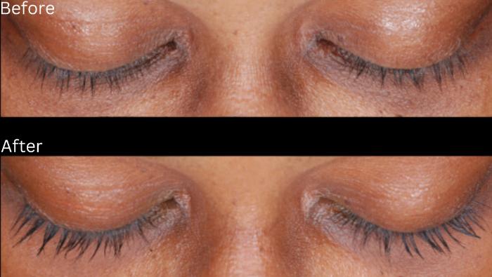 Before & After Latisse Case 354 View 1 View in Santa Rosa, California