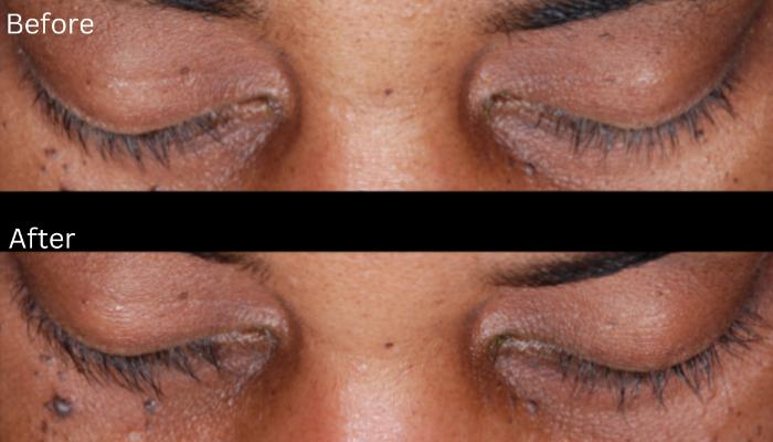 Before & After Latisse Case 355 View 1 View in Santa Rosa, California