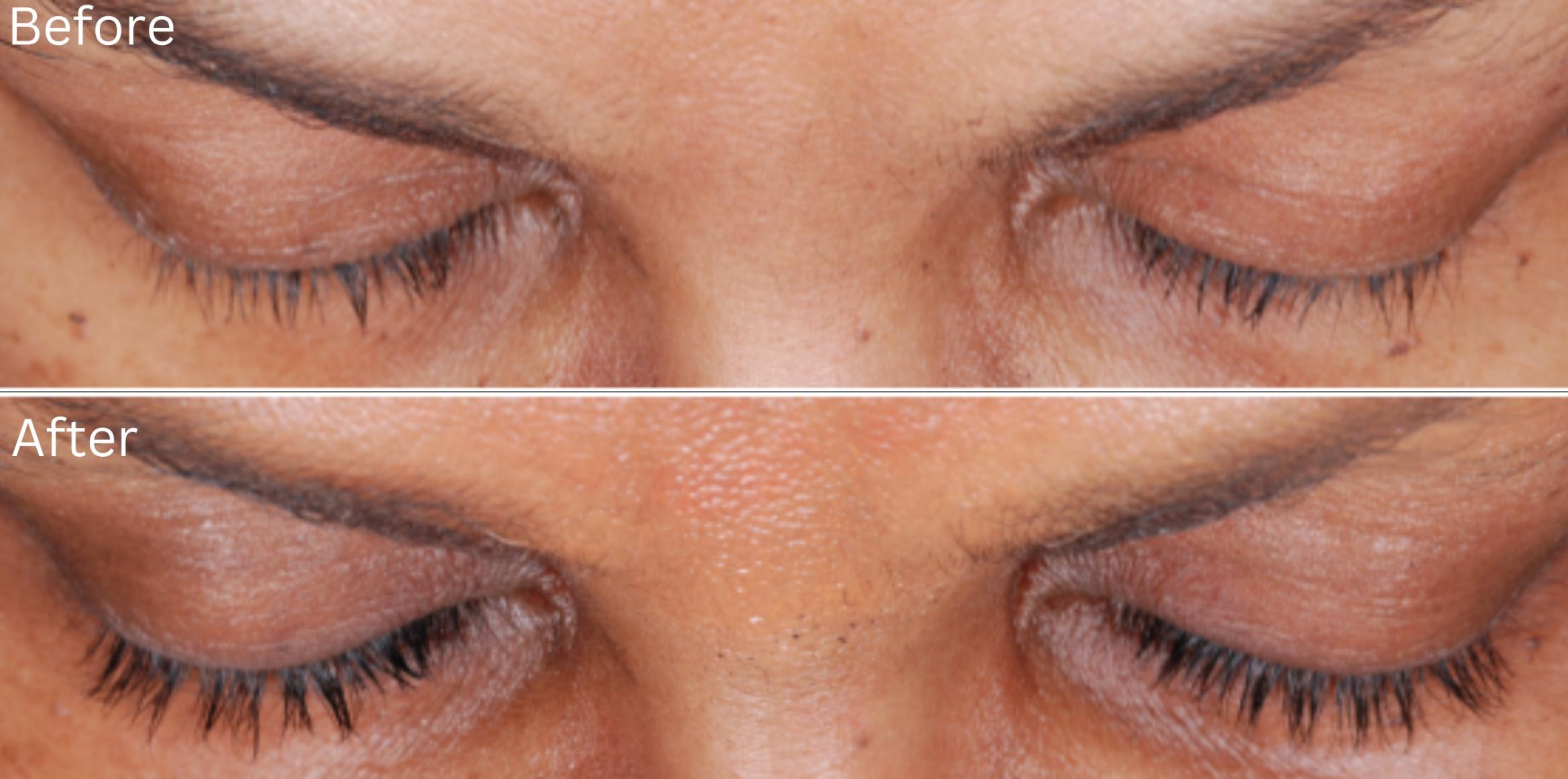 Before & After Latisse Case 356 View 1 View in Santa Rosa, California