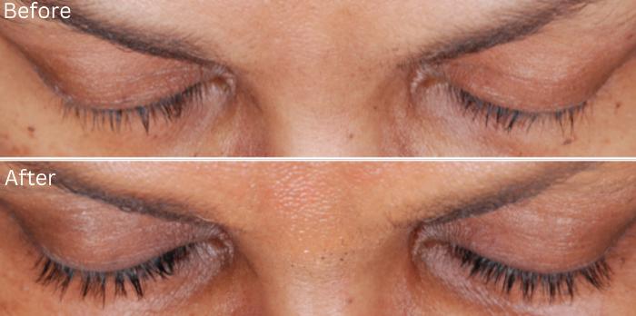 Before & After Latisse Case 356 View 1 View in Santa Rosa, California