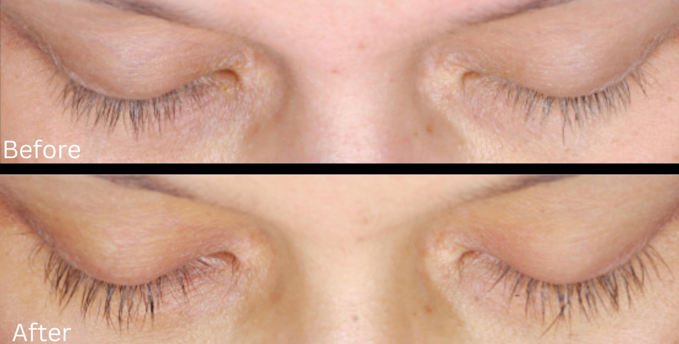Before & After Latisse Case 357 View 1 View in Santa Rosa, California