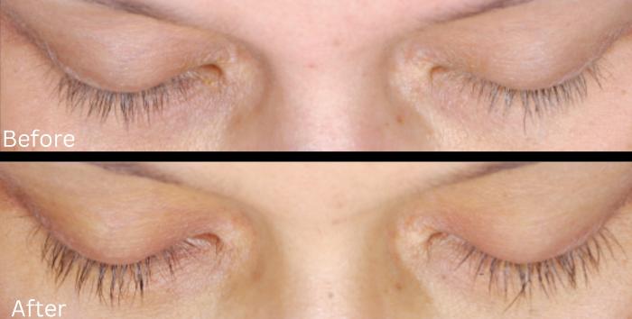 Before & After Latisse Case 357 View 1 View in Santa Rosa, California