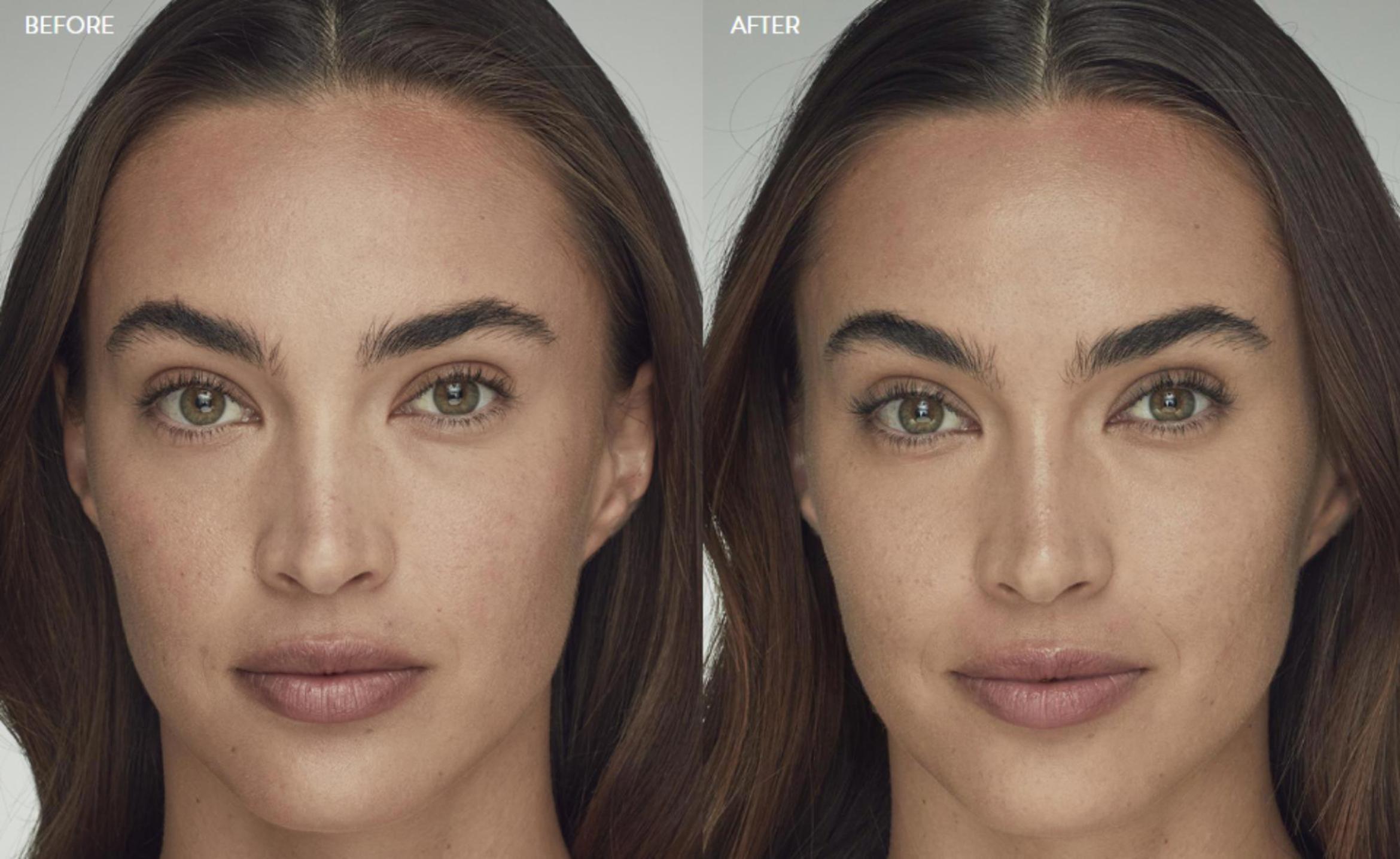 Before & After Latisse Case 358 View 1 View in Santa Rosa, California