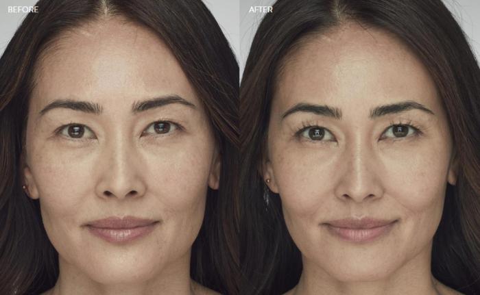 Before & After Latisse Case 359 View 1 View in Santa Rosa, California