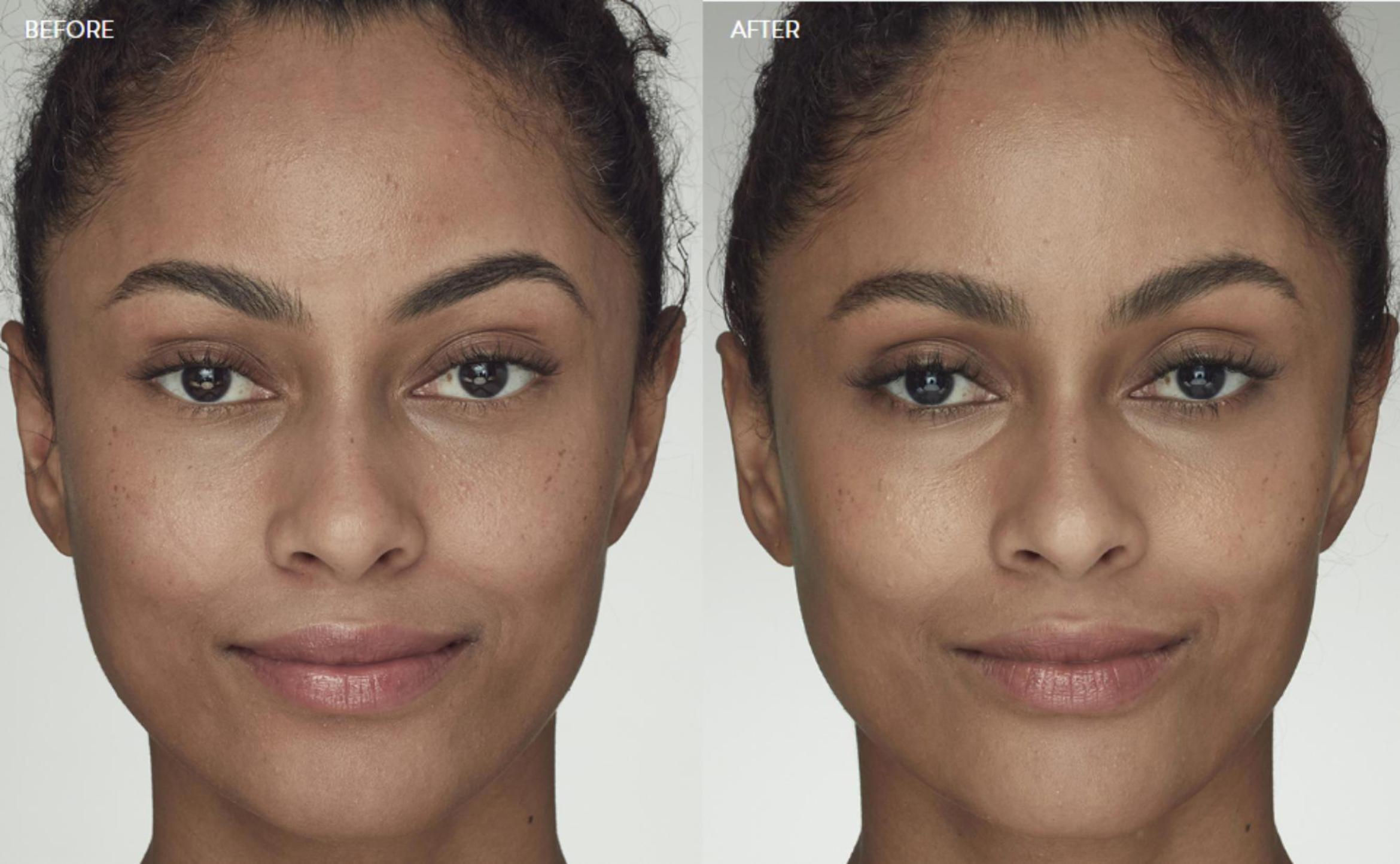Before & After Latisse Case 360 View 1 View in Santa Rosa, California