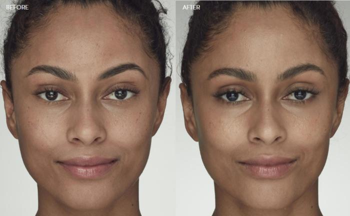 Before & After Latisse Case 360 View 1 View in Santa Rosa, California