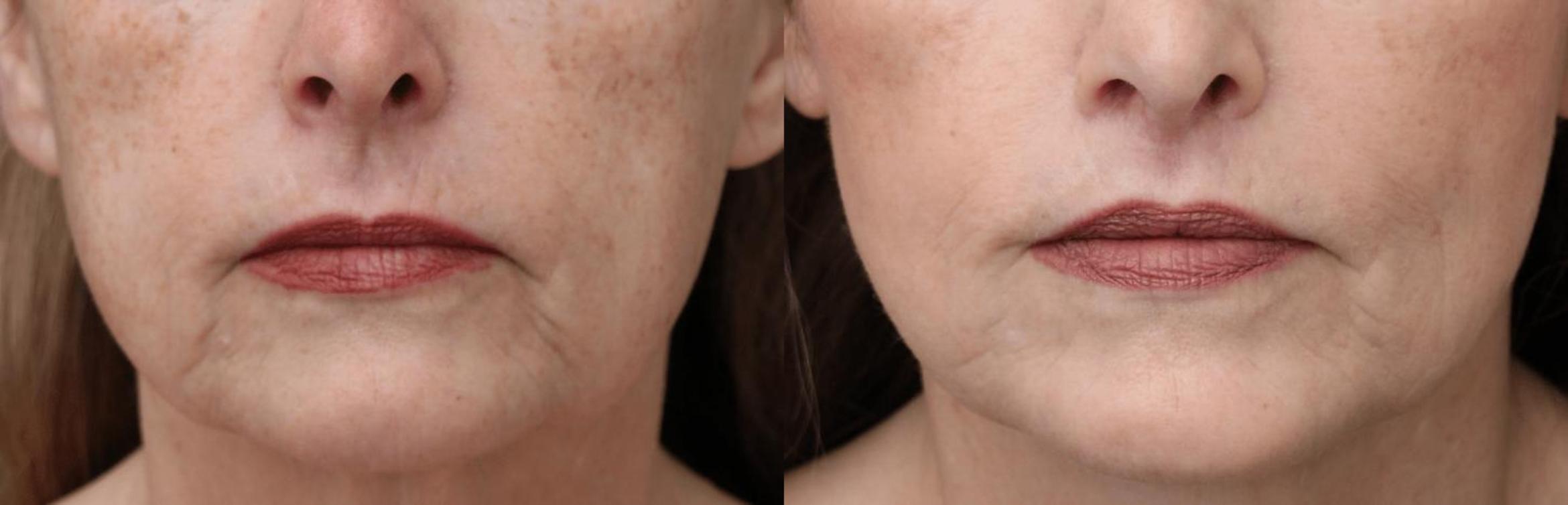 Before & After Lip Lift Case 371 View 1 View in Santa Rosa, California