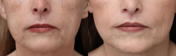 Before & After Lip Lift Case 371 View 1 View in Santa Rosa, California
