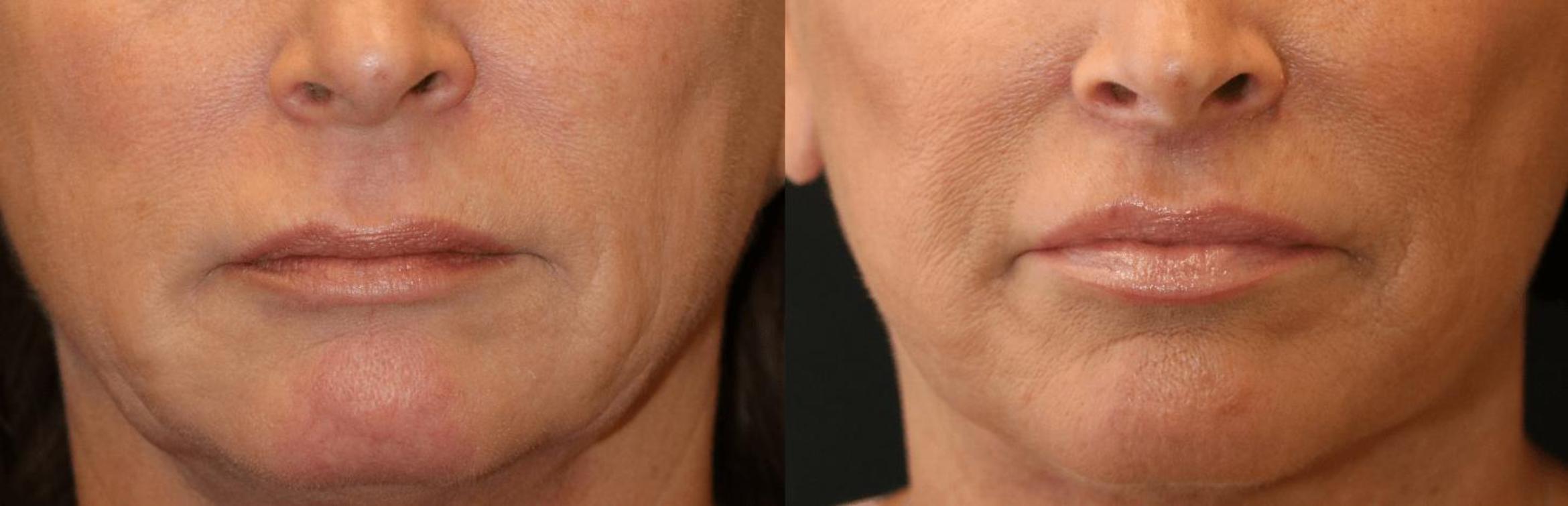 Before & After Lip Lift Case 372 View 1 View in Santa Rosa, California