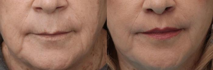 Before & After Lip Lift Case 373 View 1 View in Santa Rosa, California