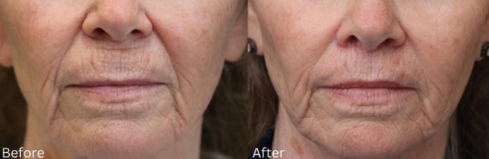 Before & After Lip Lift Case 64 View 1 View in Santa Rosa, California