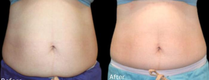 Before & After LipoCel Case 406 Front View in Santa Rosa, California