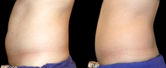Before & After LipoCel Case 407 Left Side View in Santa Rosa, California