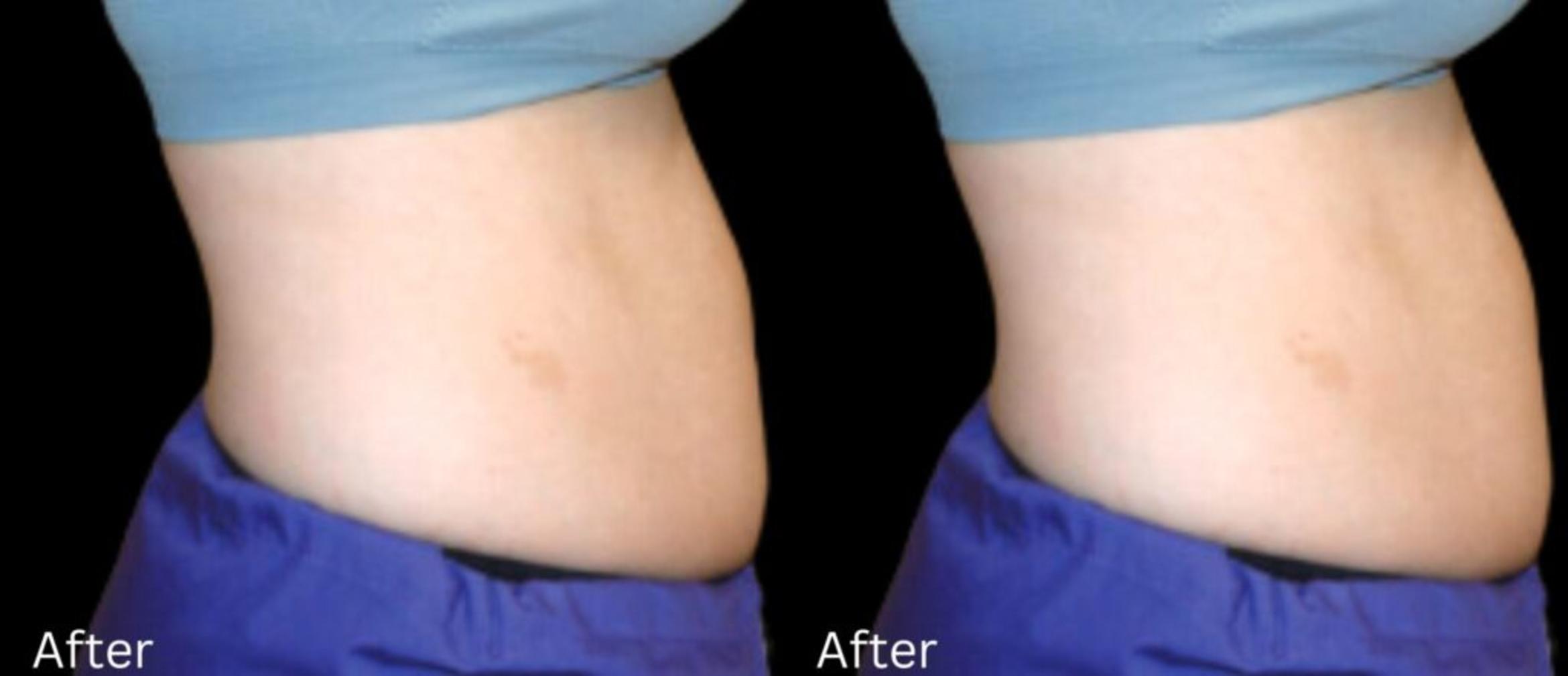 Before & After LipoCel Case 408 Right Side View in Santa Rosa, California