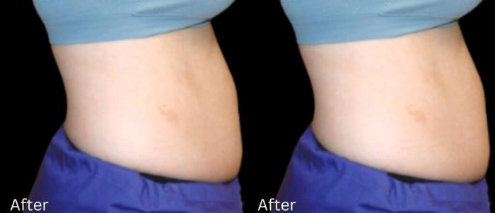 Before & After LipoCel Case 408 Right Side View in Santa Rosa, California