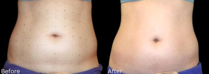 Before & After LipoCel Case 409 Front View in Santa Rosa, California