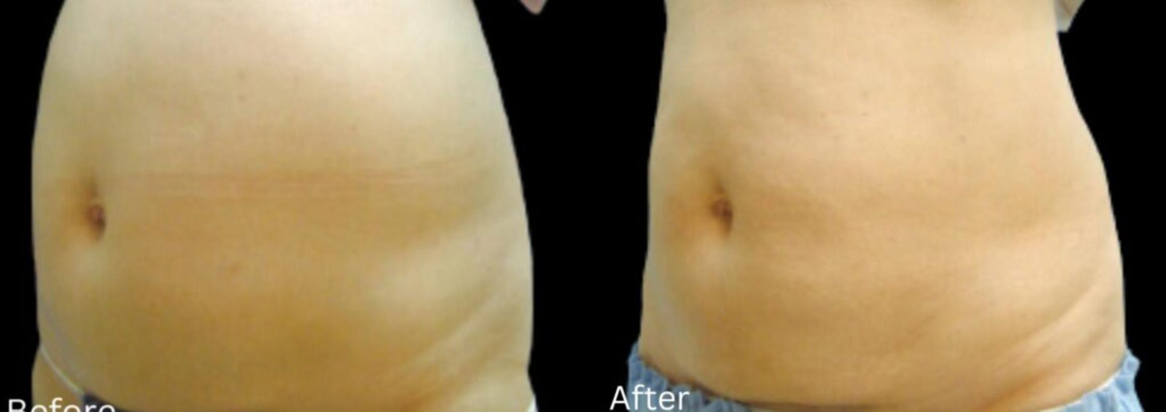 Before & After LipoCel Case 410 Left Oblique View in Santa Rosa, California