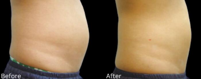 Before & After LipoCel Case 411 Right Side View in Santa Rosa, California