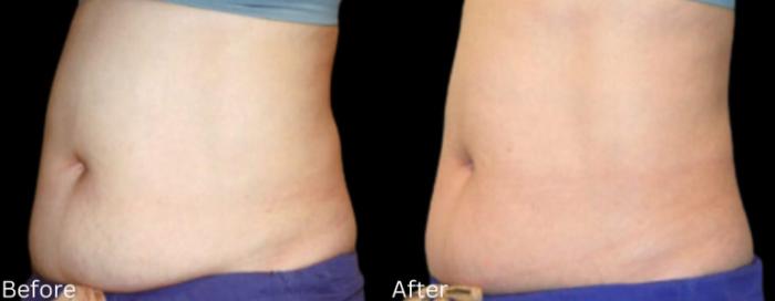 Before & After LipoCel Case 412 Left Oblique View in Santa Rosa, California