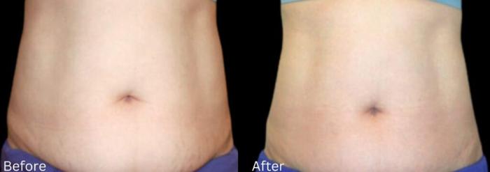 Before & After LipoCel Case 413 Front View in Santa Rosa, California