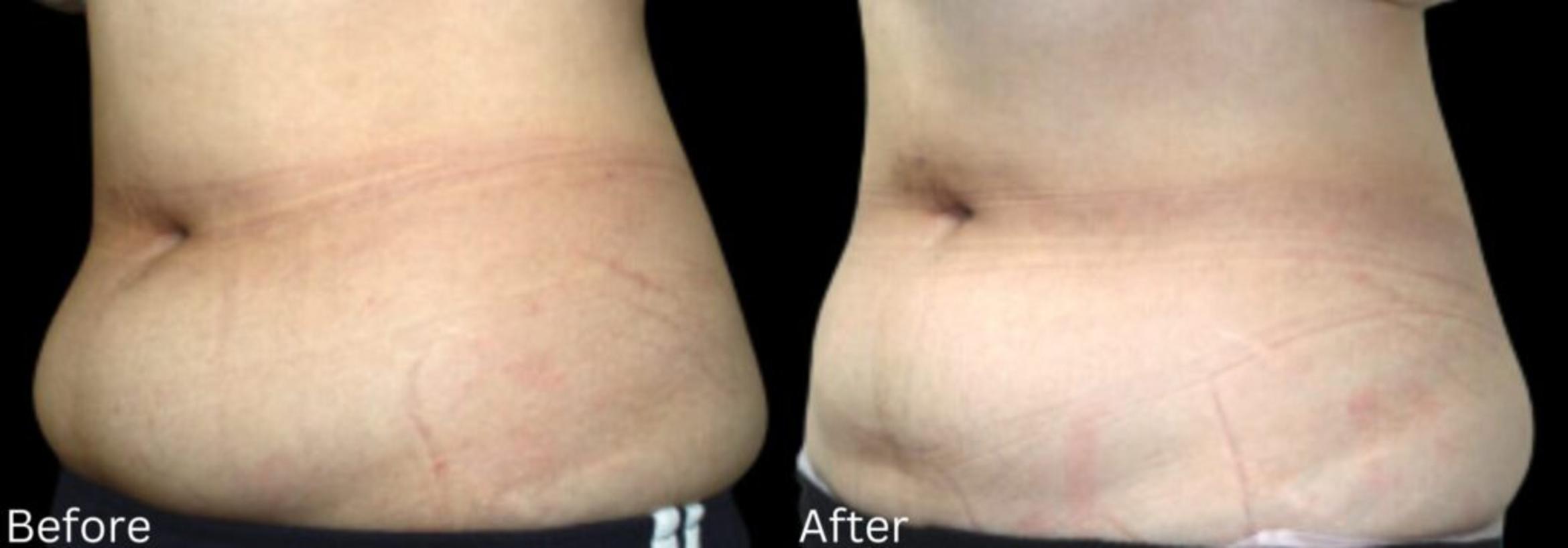 Before & After LipoCel Case 414 Left Oblique View in Santa Rosa, California