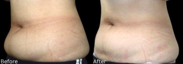 Before & After LipoCel Case 414 Left Oblique View in Santa Rosa, California
