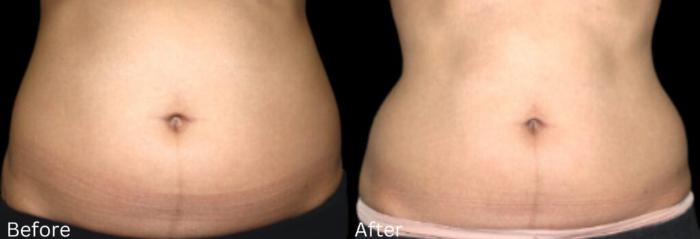 Before & After LipoCel Case 415 Front View in Santa Rosa, California