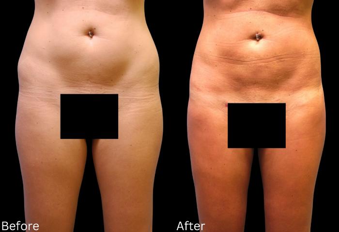 Before & After Liposuction Case 249 View 1 View in Santa Rosa, California