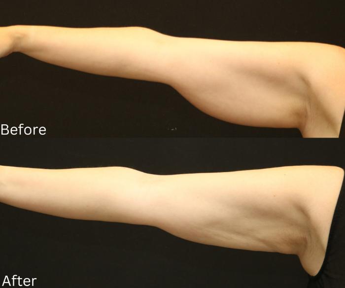Before & After Liposuction Case 77 View 1 View in Santa Rosa, California