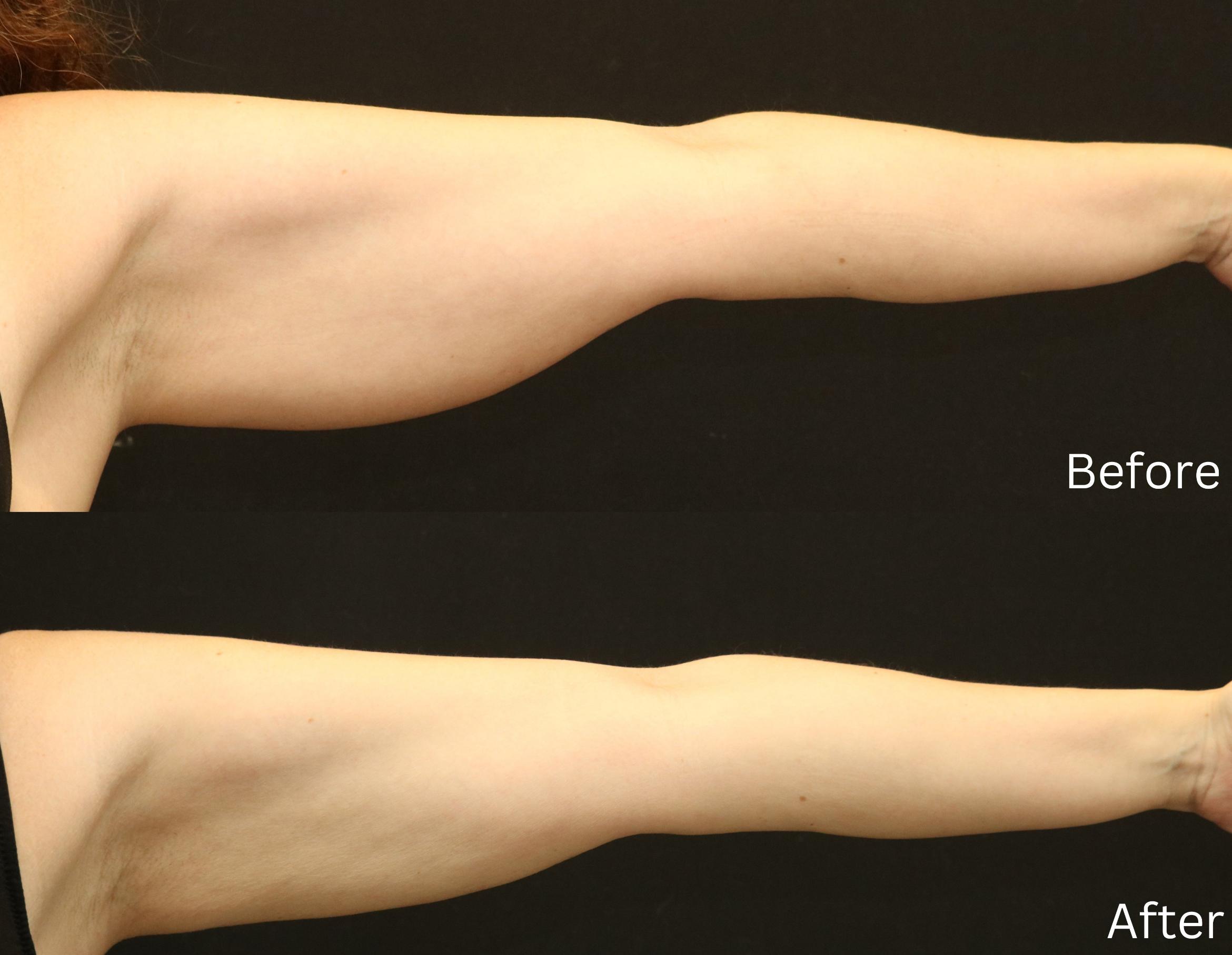Before & After Liposuction Case 77 View 2 View in Santa Rosa, California
