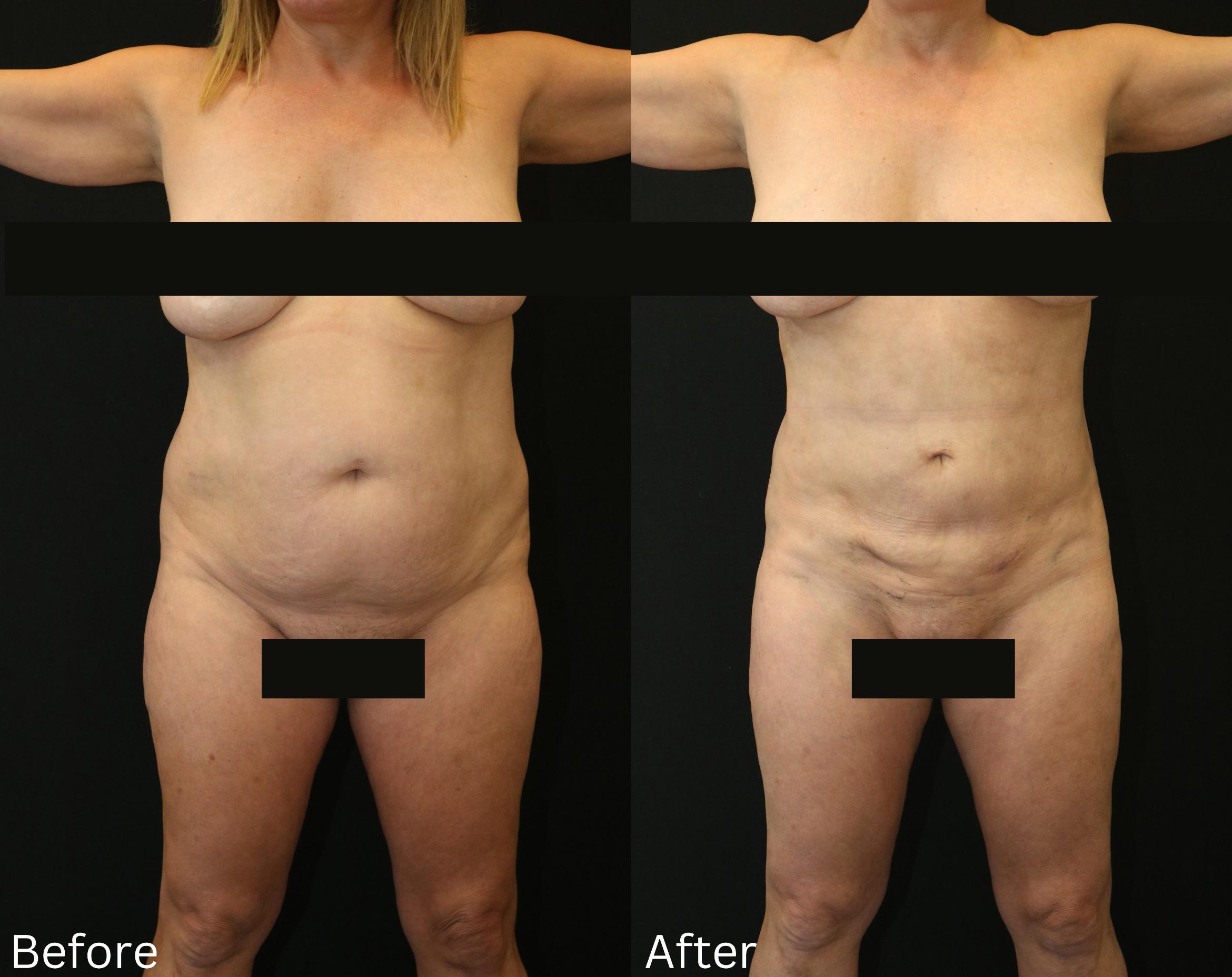 Before & After Liposuction Case 78 View 1 View in Santa Rosa, California
